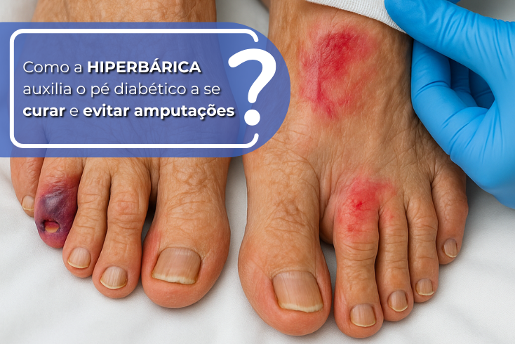 Como a Hiperbárica auxilia o Pé Diabético a se curar e evitar amputações?