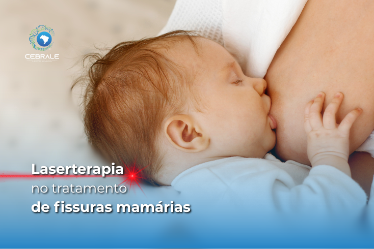 laserterapia fissuras mamárias