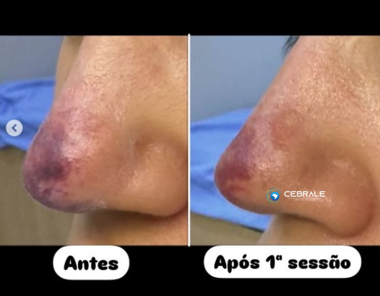 isquemia após o uso de ácido hialurônico